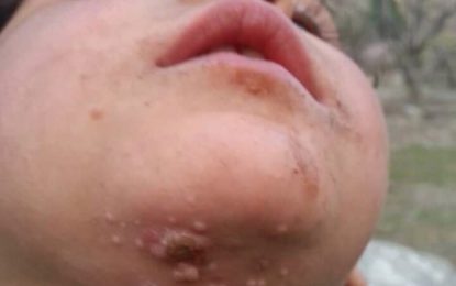 یاسین کے مختلف دیہات میں‌چکن پاکس کی وبا پھیل گئی، جسم پر سفید دانے نکل آتے ہیں‌اور بخار ایک سو دو تک بڑھ جاتا ہے